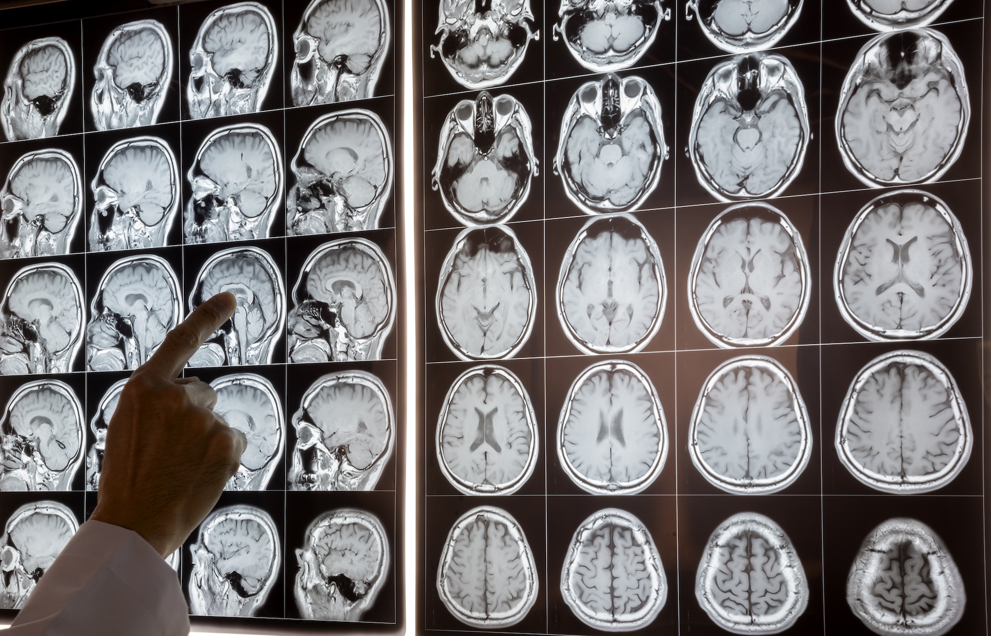 Doctor pointing at MRI of human brain on the light box to demonstrate anatomy